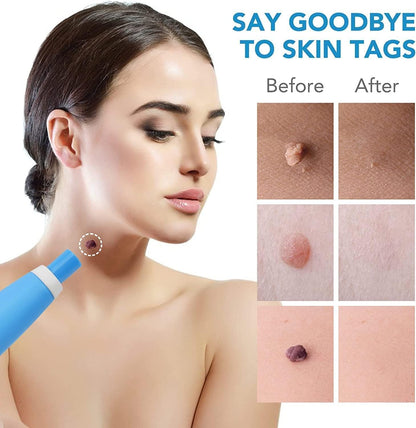 2-in-1 Skin Tag Remover Kit